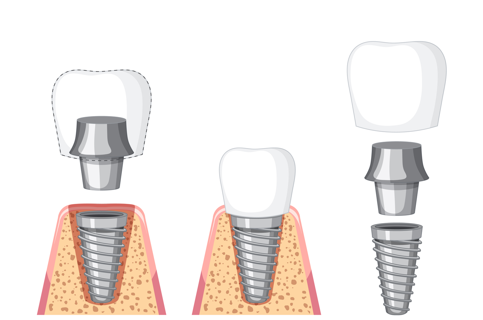 Dental Implants in Turkey: A Complete Guide for International Patients